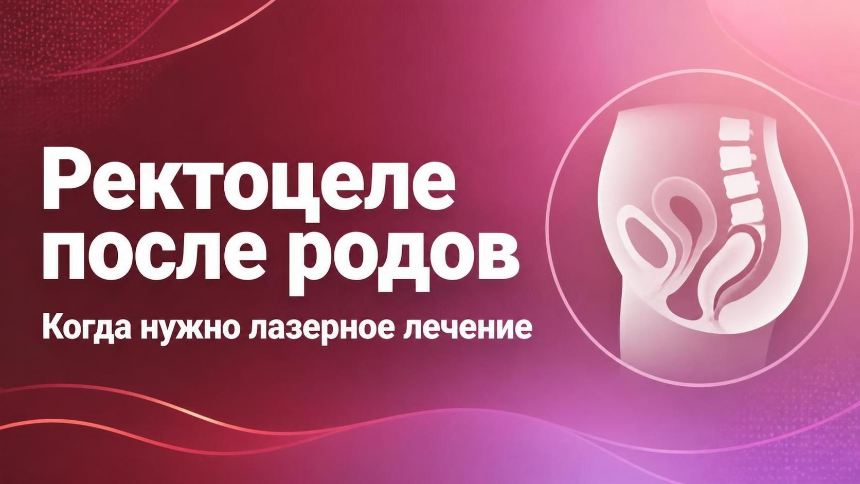 Ректоцеле после родов — симптомы и лазерное лечение