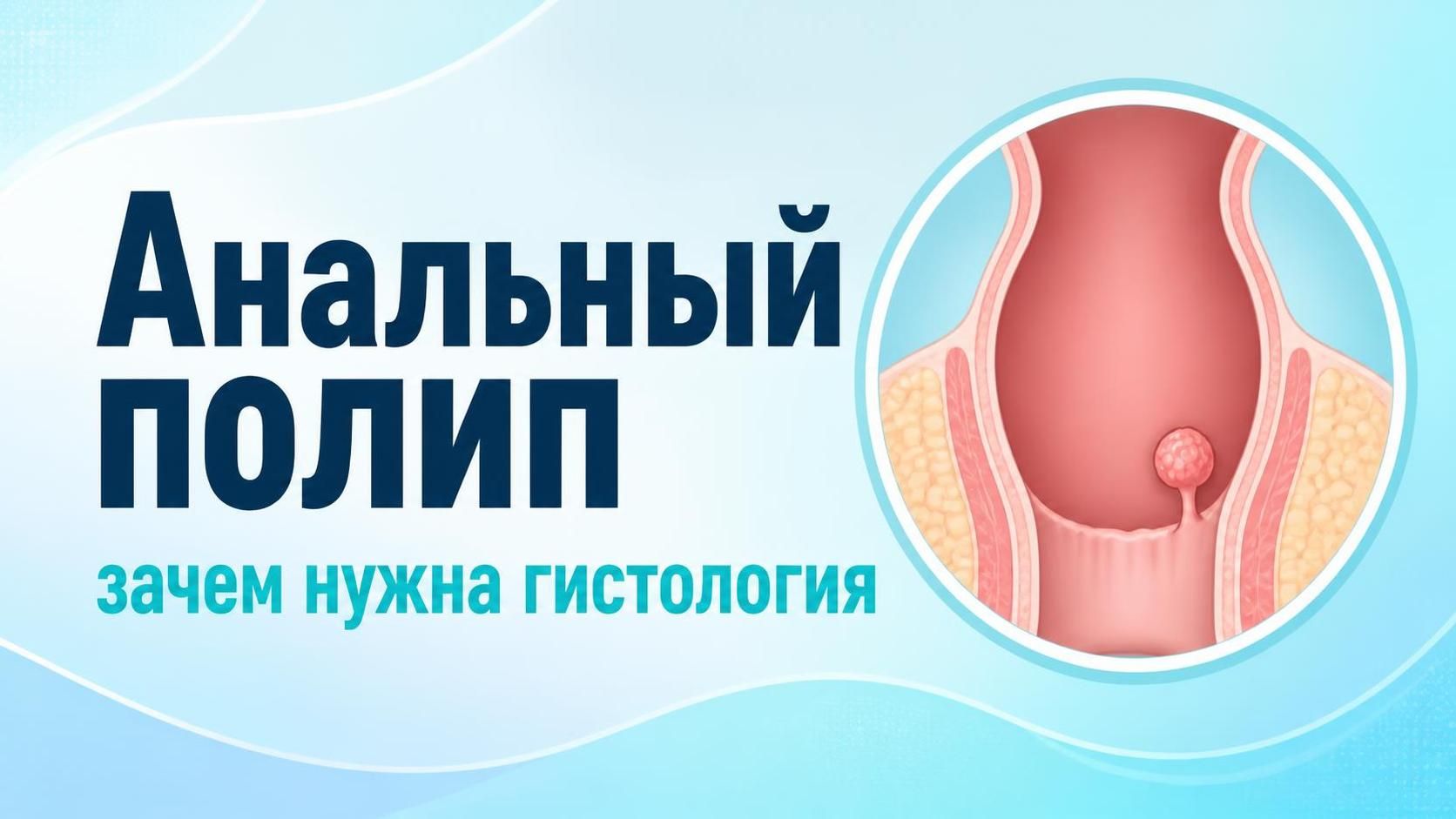 Анальный полип или геморрой — как отличить симптомы